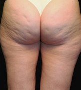 cellulite on the bum how to remove