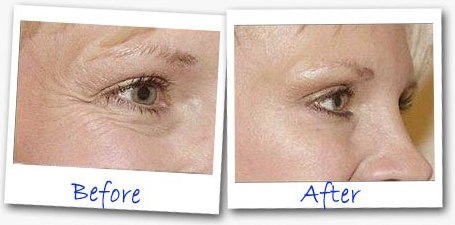 Eye Secrets Under Eye Tightener before and after