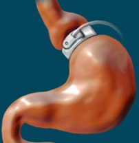 gastric band adjustable